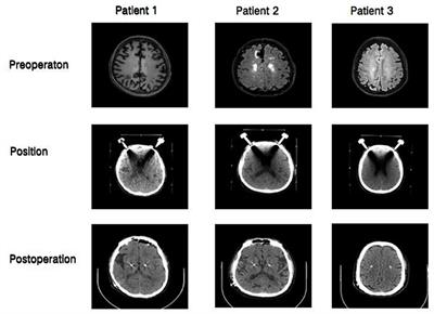 Delayed Recovery After Deep Brain Stimulation Surgery for Parkinson's Disease Under General Anesthesia-Cases Report